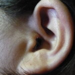 weighing the risks: who should avoid microsuction for ear wax removal 5