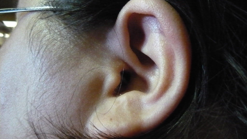 weighing the risks: who should avoid microsuction for ear wax removal 1