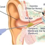 exploring the benefits and effectiveness of manual instrument ear wax removal 5