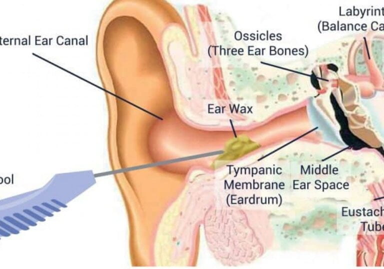 exploring the benefits and effectiveness of manual instrument ear wax removal